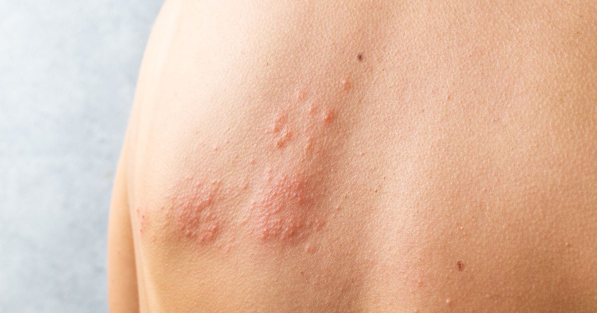 Shingles herpes outbreak symptoms duration spread 51 off