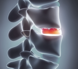 Disc generated by osteophyte formation