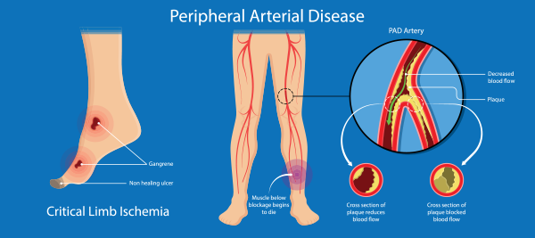 Peripheral Arterial Disease