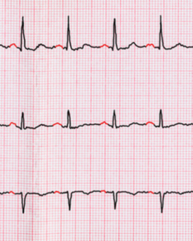 Atrial Fibrilization scan